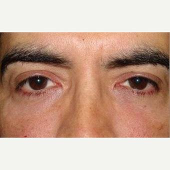 35-44 year old man treated with Restylane after 2060878