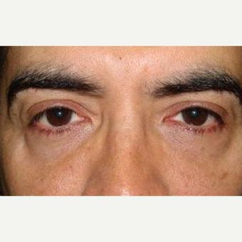 35-44 year old man treated with Restylane before 2060878