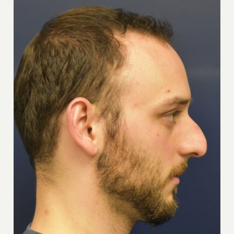 18-24 year old man treated with Nose Surgery before 3067116