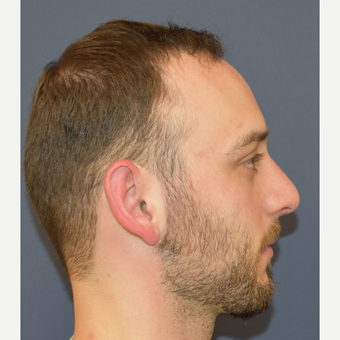 18-24 year old man treated with Nose Surgery after 3067116