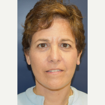 55-64 year old woman treated with Neck Lift after 3461037