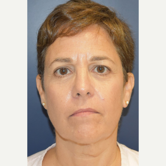 55-64 year old woman treated with Neck Lift before 3461037