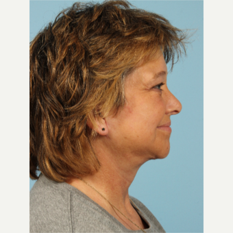 55-64 year old woman treated with Facelift after 3617718