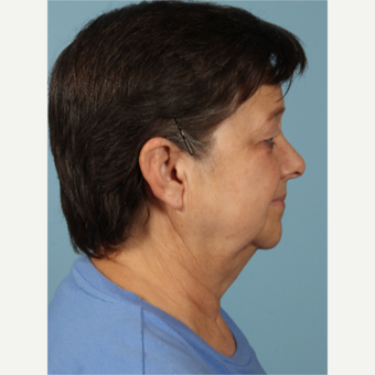 55-64 year old woman treated with Facelift before 3617718