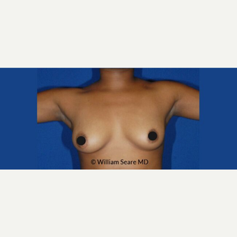 35-44 year old woman treated with Breast Fat Transfer before 3803028
