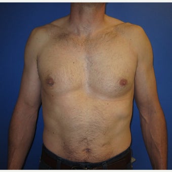39 year old gentleman with right sided gynecomastia after 1821672