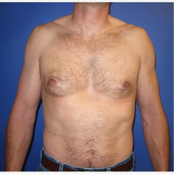 39 year old gentleman with right sided gynecomastia before 1821672