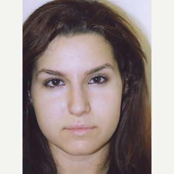 17 or under year old woman treated with Rhinoplasty after 3406152