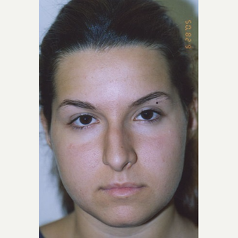 17 or under year old woman treated with Rhinoplasty before 3406152
