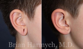 18 year-old female before and 2 months after Ear Lobe Surgery (Earlobe Repair) before 3446234