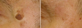 Mole Removal before 1211998