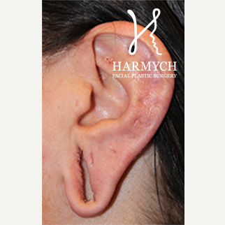 Ear Lobe Repair Surgery, 25-34 year old woman before 1950763