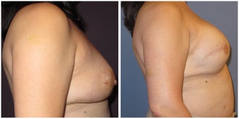 Breast Reconstruction 1395496
