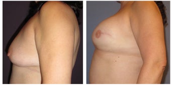 Breast Reconstruction after 1395496