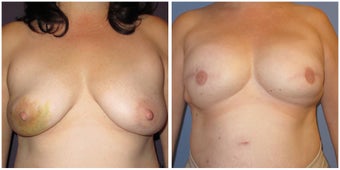 Breast Reconstruction before 1395496