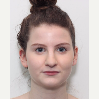 18-24 year old woman treated with Rhinoplasty before 3224892