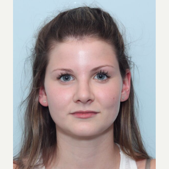 18-24 year old woman treated with Rhinoplasty after 3224892