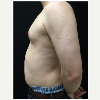 25-34 year old man treated with Male Breast Reduction before 3218524