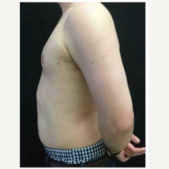 25-34 year old man treated with Male Breast Reduction after 3218524