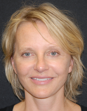 45-54 year old woman treated with Facelift after 1782743