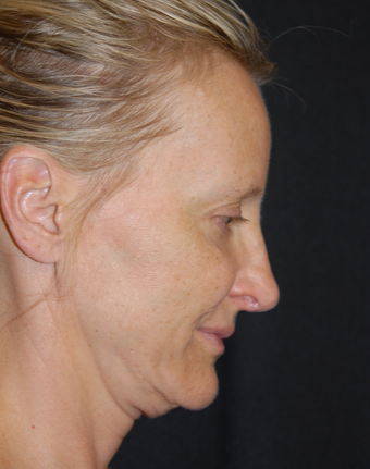 45-54 year old woman treated with Facelift 1782743