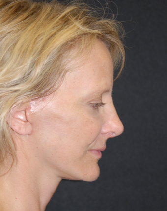 45-54 year old woman treated with Facelift 1782743