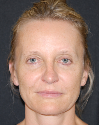 45-54 year old woman treated with Facelift before 1782743