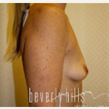 45-54 year old woman treated with Breast Implants before 1546319