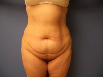 46 yo Female Abdominoplasty Tummy Tuck Mommy Makeover before 866936