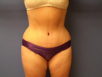 46 yo Female Abdominoplasty Tummy Tuck Mommy Makeover after 866936