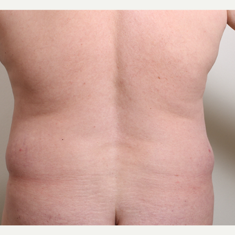 35-44 year old man treated with Liposuction of the waist (flank) before 3320078