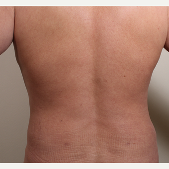 35-44 year old man treated with Liposuction of the waist (flank) after 3320078