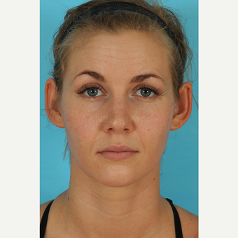 25-34 year old woman treated with Rhinoplasty after 3629432