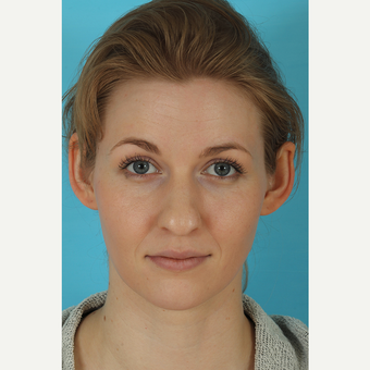 25-34 year old woman treated with Rhinoplasty before 3629432