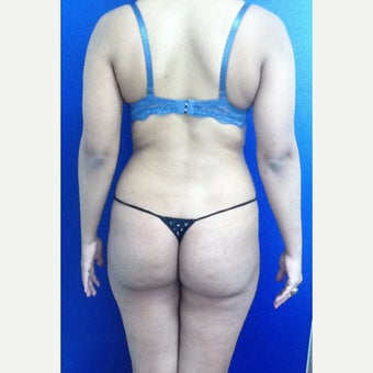 25-34 year old woman treated with Brazilian Butt Lift before 1986020