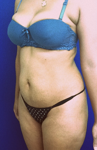 25-34 year old woman treated with Brazilian Butt Lift 1986020