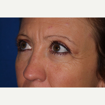 Eyelid Surgery after 3744054