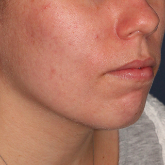 18-24 year old woman treated with Photodynamic Therapy after 3076882