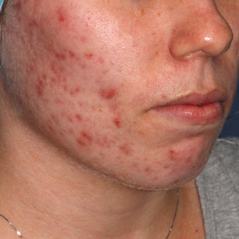 18-24 year old woman treated with Photodynamic Therapy before 3076882