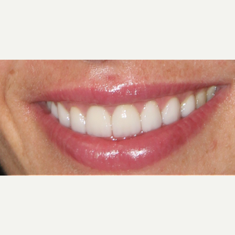 25-34 year old woman treated with Smile Makeover after 3213212