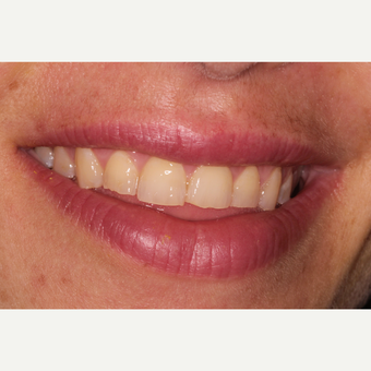25-34 year old woman treated with Smile Makeover before 3213212