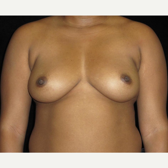 29 year old woman treated with Breast Implants before 3252468