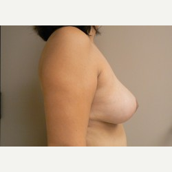 Breast Lift after 3373426