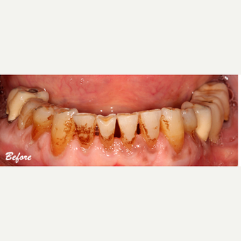 55-64 year old man treated with Dental Crown before 3577706