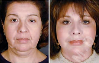 Complete Facial Rejuvenation before 138187