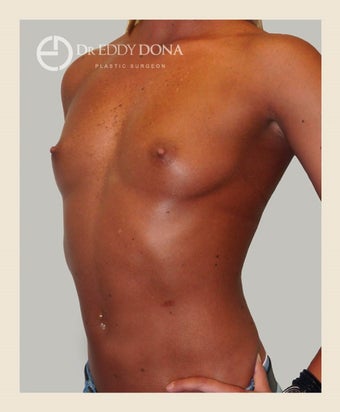 25-34 year old woman treated with Breast Augmentation 1672216