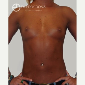 25-34 year old woman treated with Breast Augmentation before 1672216