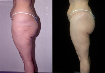 50-year-old woman treated with a Thigh Lift. after 574586