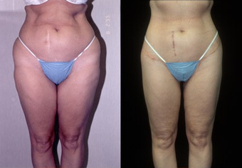 50-year-old woman treated with a Thigh Lift. before 574586