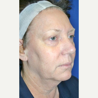 55-64 year old woman treated with Neck Lift before 3055626